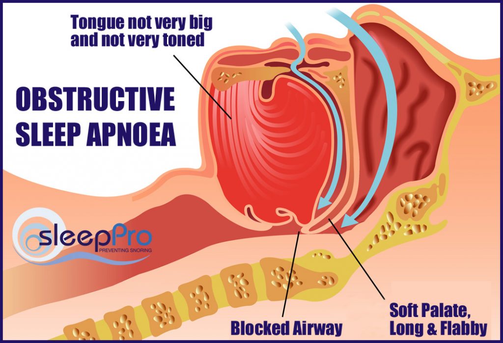 Some snoring is harmful and some isn’t – and this is how to tell the difference